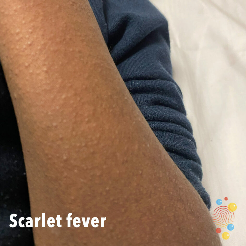 child's arm showing scarlet fever as rash indistinguishable by colour on brown skin