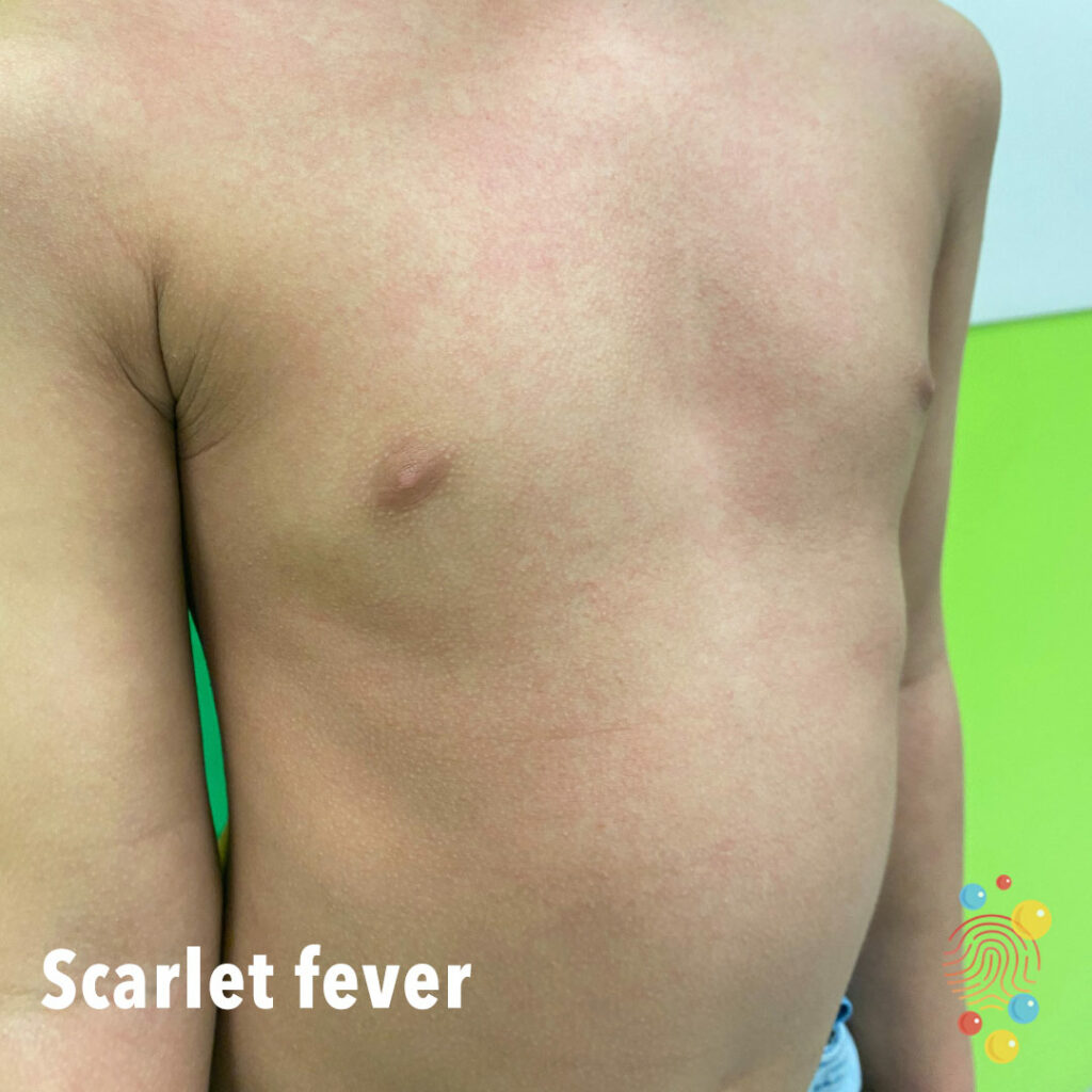 child's torso showing scarlet fever as pinkish rash on white or pale skin