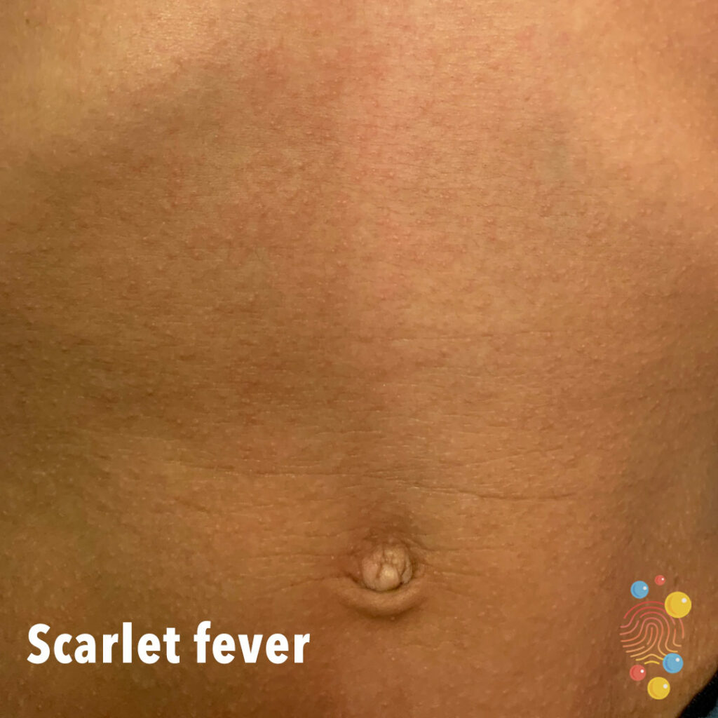 child's torso showing scarlet fever as almost indistinguishable rash on brown skin