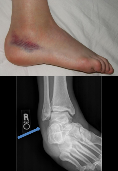 Ankle avulsion fracture