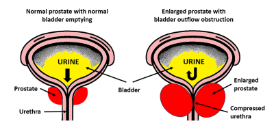 The image shows two diagrams, firstly a normal prostate (in red) with the bladder emptying normally. The right diagram shows an enlarged prostate in red compressing the urethra and obstructing the flow of urine. 