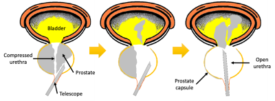 The image shows a telescope inserted into the urethra and the laser being used to shell out the prostate. The second image shows the prostate being pushed into the bladder. The last image shows the rest of the prostate being into the bladder before it is chopped up and suctioned out.