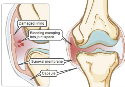 A diagram of a joint showing damaged lining.